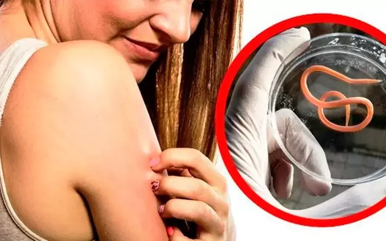 kruajtje dhe acarim për shkak të parazitëve në trup