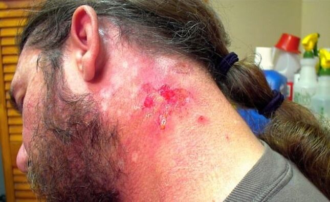 Plagë gjakderdhje në qafë me virusin Morgellons