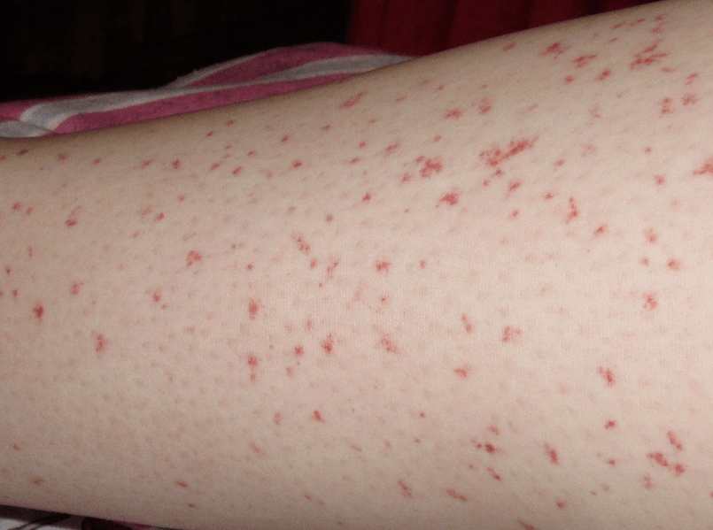 Skuqja e lëkurës është shenjë e një faze akute të infeksionit me krimba